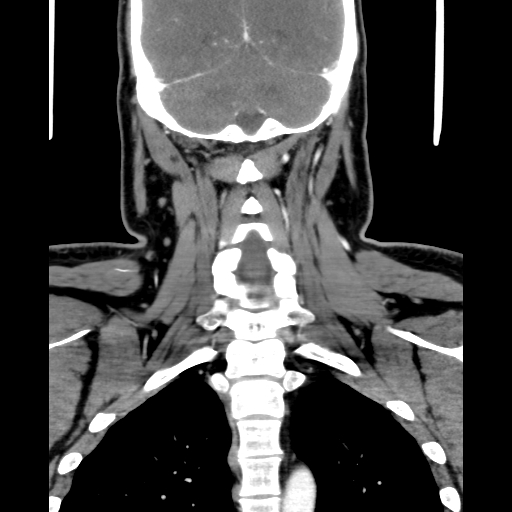 Bilateral peritonsillar abscess (Radiopaedia 85065-100610 Coronal 56).jpg