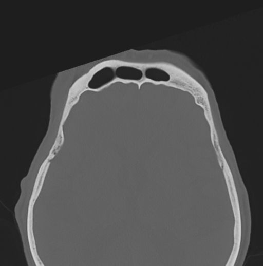 File:Bilateral preseptal periorbital cellulitis (Radiopaedia 43081-46350 Axial bone window 7).png