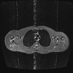 File:Bilateral spinoglenoid notch ganglion cysts (Radiopaedia 29577-30082 E 12).jpg