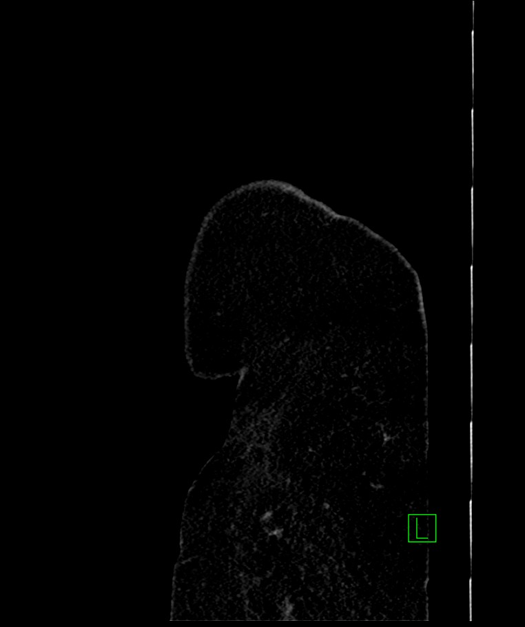 Bilateral sporadic synchronous clear cell renal cell carcinoma (Radiopaedia 85035-100575 E 3).jpg