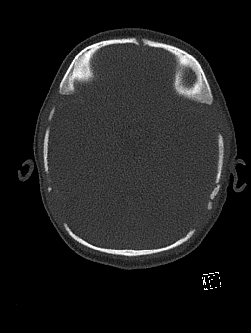 Bilateral subdural hemorrhage and parietal skull fracture (Radiopaedia 26058-26192 Axial bone window 91).png