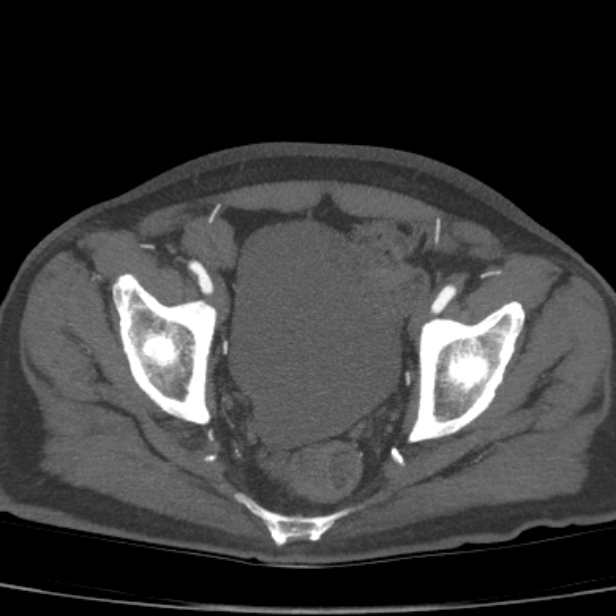 Bilateral superficial femoral arterial occlusion (Radiopaedia 25682-25857 A 23).jpg