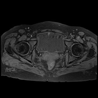 Bilateral tubo-ovarian abscesses (Radiopaedia 58635-65829 Axial T1 fat sat 34).jpg