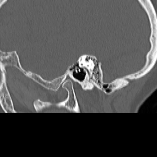 Bilateral tympanoplasty (Radiopaedia 16947-16664 Sagittal bone window 21).jpg