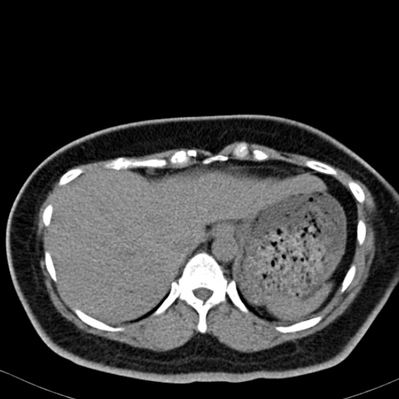 File:Bilateral ureteric stents (Radiopaedia 48795-53825 Axial non-contrast 4).jpg