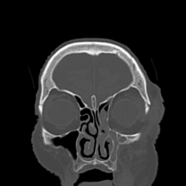 Biparietal osteodystrophy (Radiopaedia 46109-50463 Coronal bone window 23).jpg