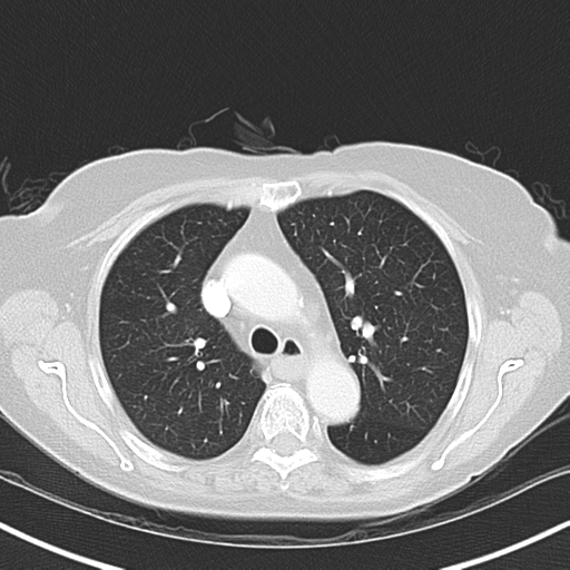 File:Bladder and bowel cancers (Radiopaedia 37688-39592 Axial lung window 18).png
