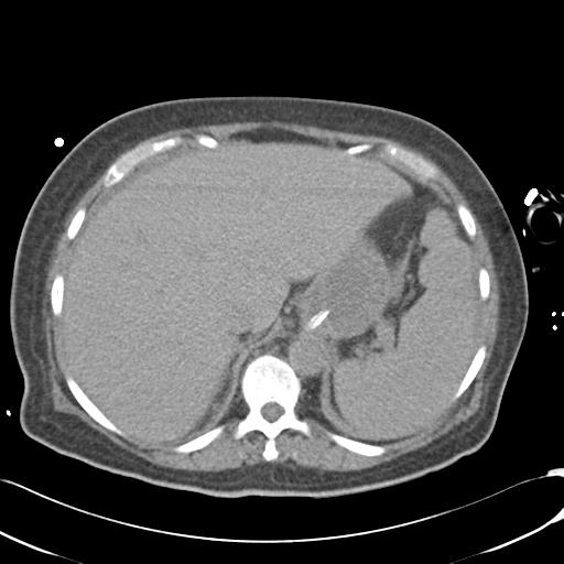 Bladder rupture post renal biopsy (Radiopaedia 30863-31572 Axial non-contrast 18).jpg