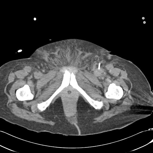 Bladder rupture post renal biopsy (Radiopaedia 30863-31572 Axial non-contrast 91).jpg