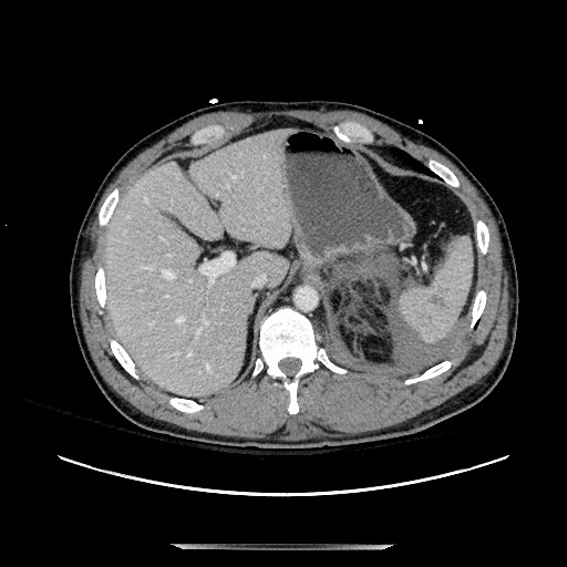 Blunt abdominal trauma with solid organ and musculoskelatal injury with active extravasation (Radiopaedia 68364-77895 A 29).jpg