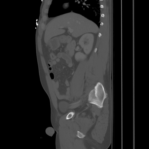 Blunt abdominal trauma with solid organ and musculoskelatal injury with active extravasation (Radiopaedia 68364-77895 Sagittal bone window 33).jpg