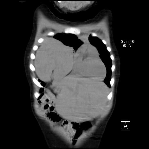 File:Bochdalek diaphragmatic hernia (Radiopaedia 38866-41059 Coronal liver window 5).jpg