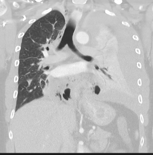 Boerhaave syndrome (Radiopaedia 39382-41661 Coronal lung window 26).png