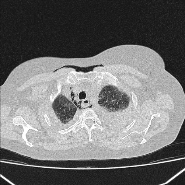 Boerhaave syndrome (Radiopaedia 45644-49799 Axial lung window 37).jpg