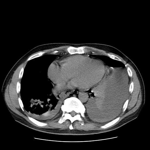 File:Boerhaave syndrome (Radiopaedia 59796-67310 Axial liver window 43).jpg