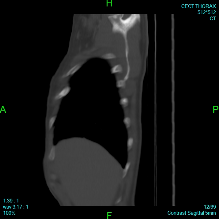 Bone metastases from lung carcinoma (Radiopaedia 54703-60937 Sagittal bone window 12).jpg