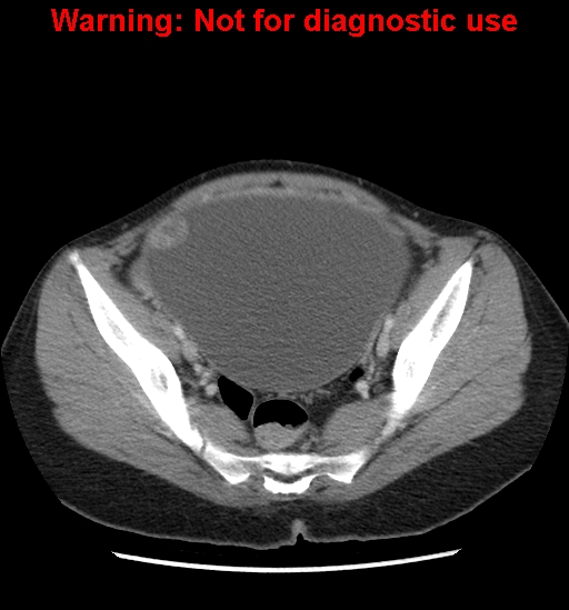 Borderline mucinous cystadenoma of ovary (Radiopaedia 25586-25767 A 90).jpg