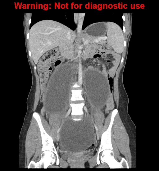 Borderline mucinous cystadenoma of ovary (Radiopaedia 25586-25767 B 37).jpg