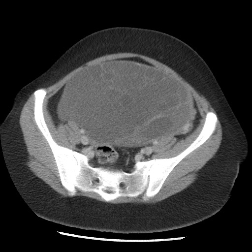 File:Borderline mucinous tumor (ovary) (Radiopaedia 78228-90808 A 117).jpg
