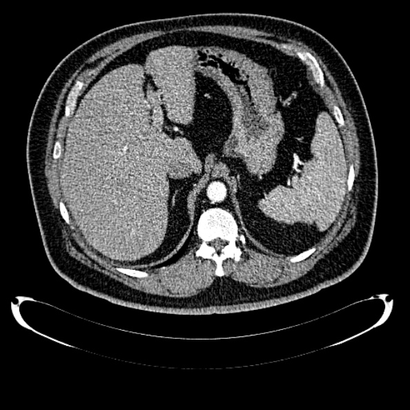 Bosniak renal cyst - type IV (Radiopaedia 24244-24518 B 67).jpg