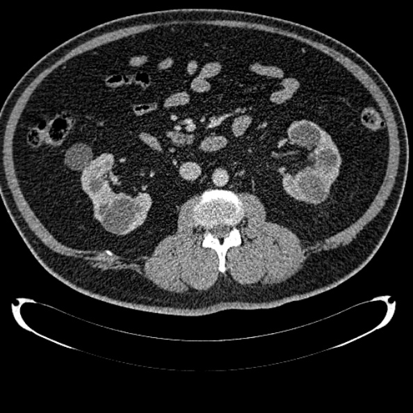 Bosniak renal cyst - type IV (Radiopaedia 24244-24518 C 173).jpg