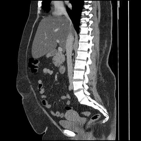 Bowel and splenic infarcts in acute lymphocytic leukemia (Radiopaedia 61055-68913 C 44).jpg