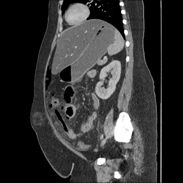 Bowel and splenic infarcts in acute lymphocytic leukemia (Radiopaedia 61055-68915 C 26).jpg
