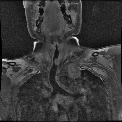File:Brachial plexus neurofibroma (Radiopaedia 28030-28291 H 1).png