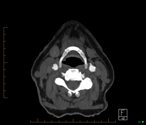 File:Brachiocephalic trunk stenosis (Radiopaedia 87242-103519 A 96).jpg