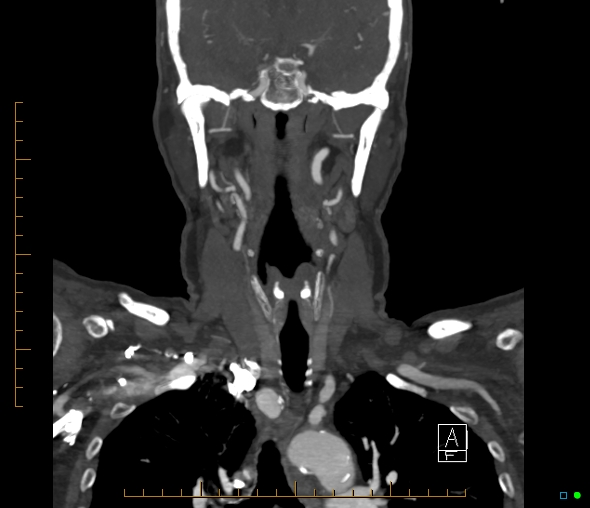 Brachiocephalic trunk stenosis (Radiopaedia 87242-103519 B 35).jpg