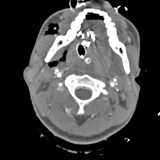 Brain contusions, internal carotid artery dissection and base of skull fracture (Radiopaedia 34089-35339 D 61).png