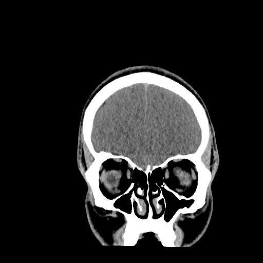 Brain death (Radiopaedia 78597-91360 Coronal non-contrast 17).jpg