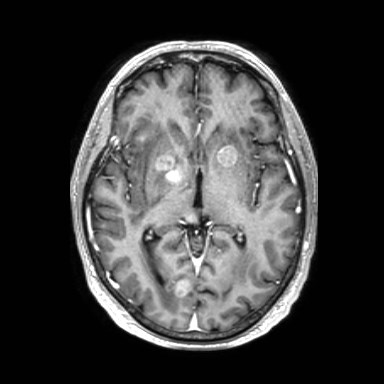 File:Brain metastases from lung cancer (Radiopaedia 83839-99028 Axial T1 C+ 30).jpg