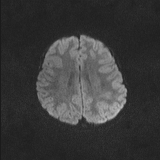 Brainstem glioma (Radiopaedia 67531-76922 Axial DWI 63).jpg