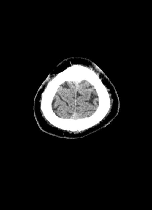 Brainstem hemorrhage (Radiopaedia 81294-94976 Axial non-contrast 7).jpg