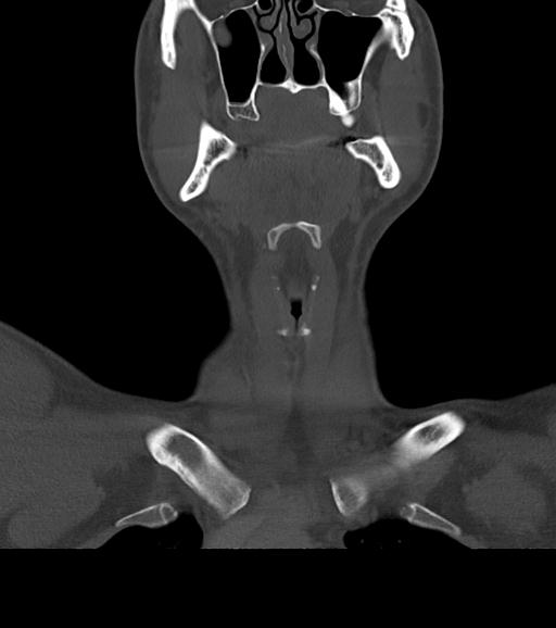 Branchial cleft cyst (Radiopaedia 31167-31875 Coronal bone window 23).jpg