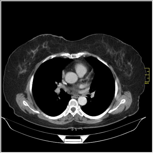 Breast cancer on thorax CT (Radiopaedia 60571-68275 A 52).JPG