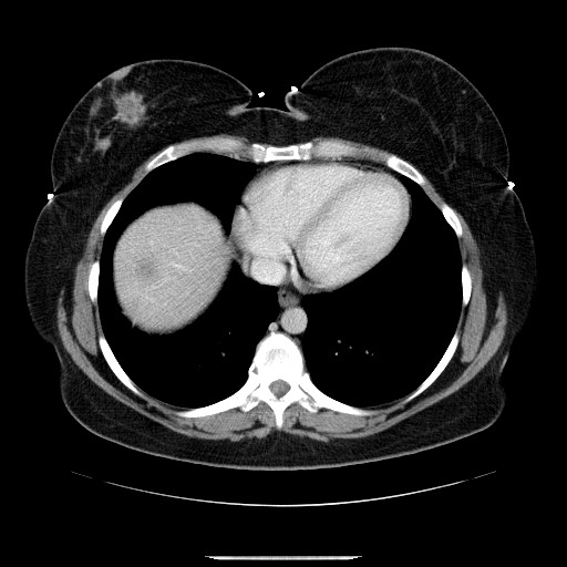 File:Breast cancer pseudocirrhosis after chemotherapy (Radiopaedia 65407-74456 A 9).jpg