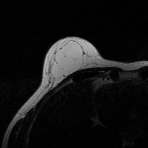 File:Breast lipoma and cancer (Radiopaedia 15118-14995 Axial T2 23).jpg