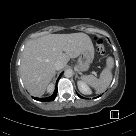 File:Breast metastases from renal cell cancer (Radiopaedia 79220-92225 C 18).jpg