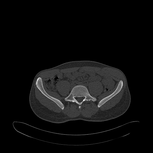 Brodie abscess- femoral neck (Radiopaedia 53862-59966 Axial bone window 1).jpg