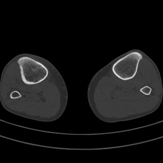 File:Brodie abscess - tibia (Radiopaedia 66028-75204 Axial bone window 16).jpg