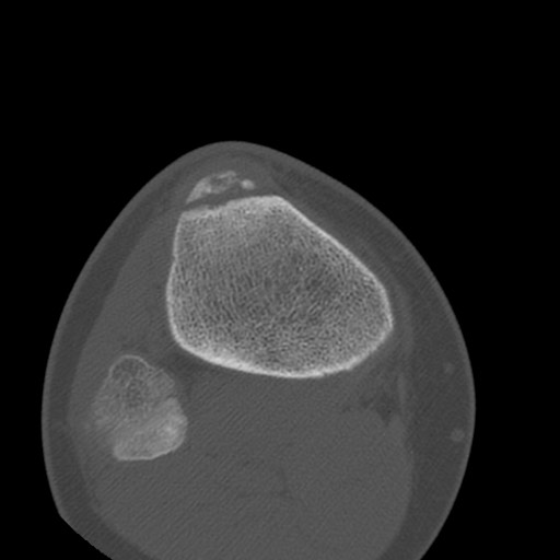 Brodie abscess of the tibia (Radiopaedia 58984-66250 Axial bone window 77).jpg