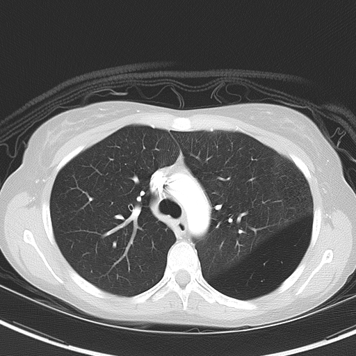 Bronchial atresia (Radiopaedia 73677-84470 Axial lung window 22).jpg