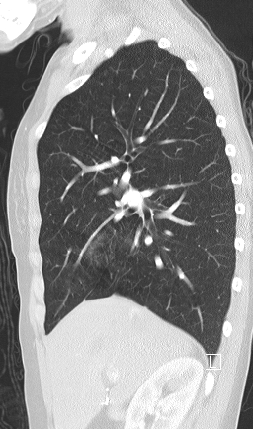 Bronchial atresia (Radiopaedia 73677-84470 Sagittal lung window 19).jpg