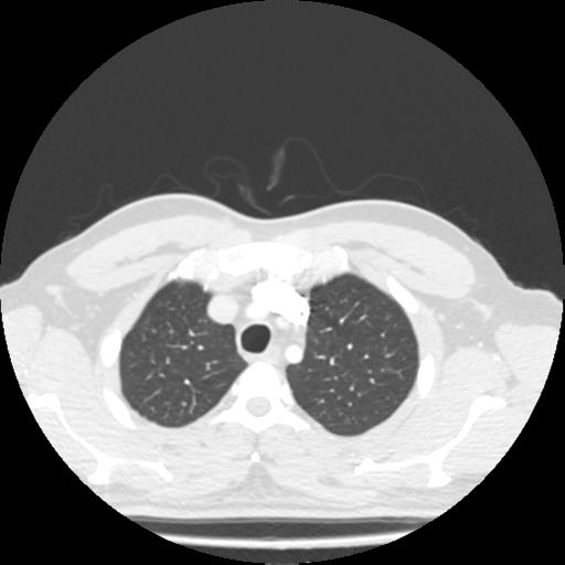 File:Bronchial carcinoid (Radiopaedia 80013-93291 Axial lung window 11).jpg