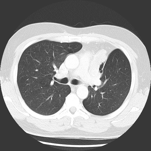 Bronchial carcinoid tumor (Radiopaedia 67377-76764 Axial lung window 27).jpg