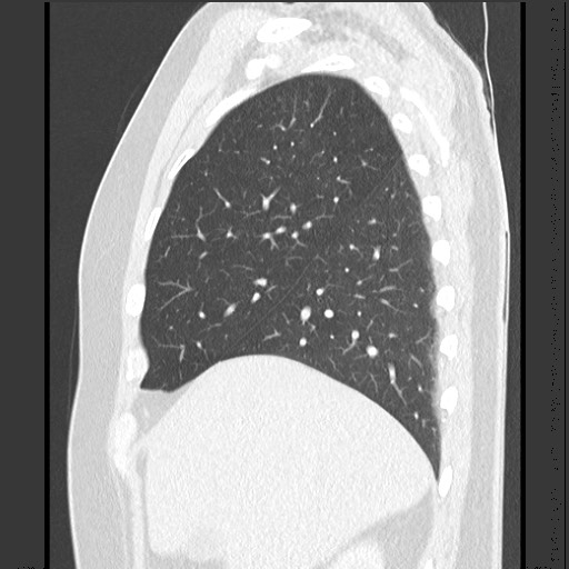 Bronchial carcinoid tumor (Radiopaedia 67377-76764 Sagittal lung window 17).jpg