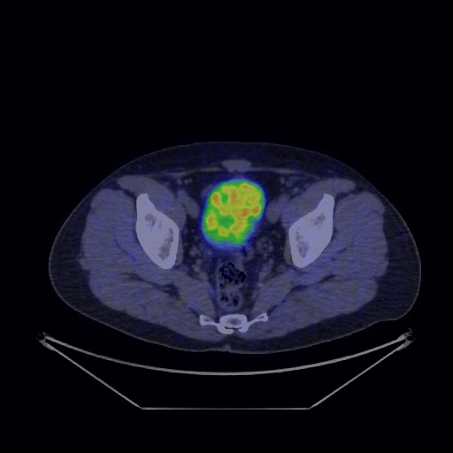 Bronchial carcinoid tumor (Radiopaedia 67377-76765 68Ga-DOTATATE PET-CT 69).jpg