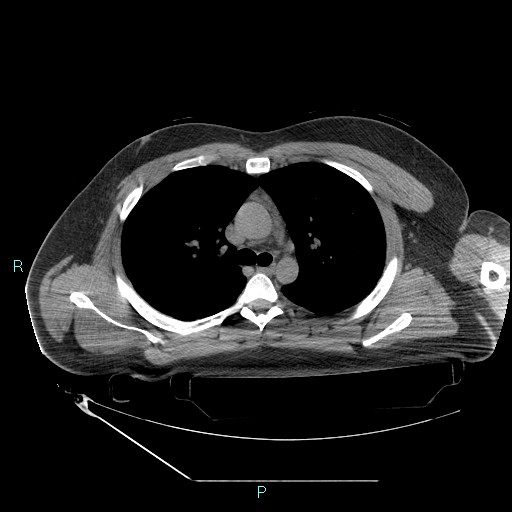 Bronchial carcinoid tumor (Radiopaedia 78272-90870 Axial non-contrast 37).jpg